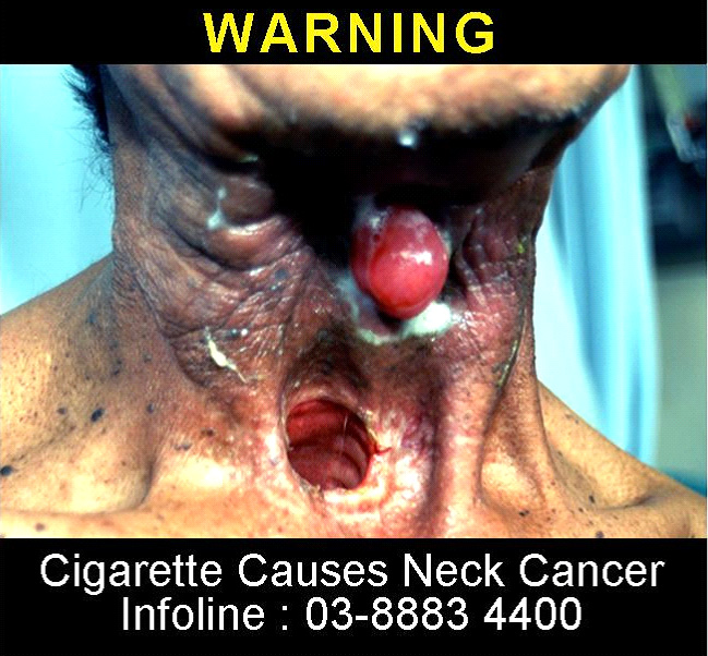 Malaysia 2008 Health Effects Other - neck cancer, lived experience, gross (back)